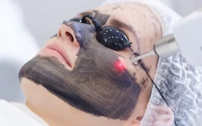 What is Carbon facial?