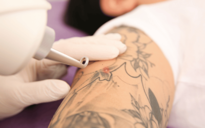 All you need to know about Tattoo Removal San Antonio