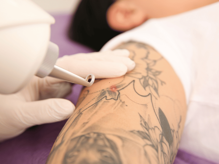 All you need to know about Tattoo Removal in San Antonio